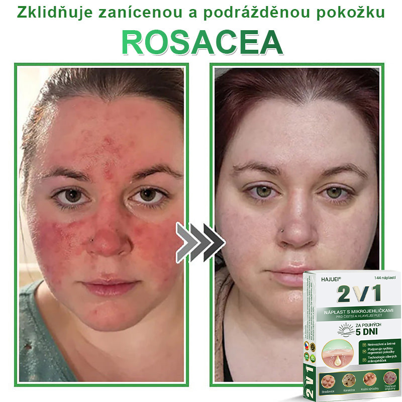 HAJUEI® 📌 𝟐𝐯𝟏 𝐡𝐲𝐝𝐫𝐨𝐤𝐨𝐥𝐨𝐢𝐝𝐧í 𝐧á𝐩𝐥𝐚𝐬𝐭𝐢 𝐬 𝐦𝐢𝐤𝐫𝐨𝐣𝐞𝐡𝐥𝐢č𝐤𝐚𝐦𝐢 | 𝐒𝐩𝐞𝐜𝐢á𝐥𝐧ě 𝐯𝐲𝐯𝐢𝐧𝐮𝐭é 𝐩𝐫𝐨 𝐨𝐝𝐬𝐭𝐫𝐚𝐧ě𝐧í 𝐯𝐲𝐬𝐭𝐨𝐮𝐩𝐥ý𝐜𝐡 𝐦𝐚𝐭𝐞ř𝐬𝐤ý𝐜𝐡 𝐳𝐧𝐚𝐦é𝐧𝐞𝐤, 𝐚𝐤𝐧é, 𝐩𝐥𝐨𝐜𝐡ý𝐜𝐡 𝐛𝐫𝐚𝐝𝐚𝐯𝐢𝐜 𝐚 𝐤𝐨ž𝐧í𝐜𝐡 𝐯ý𝐫ů𝐬𝐭𝐤ů | 𝐁𝐚𝐥𝐞𝐧í 𝟏𝟒𝟒 𝐤𝐮𝐬ů🌵🌵