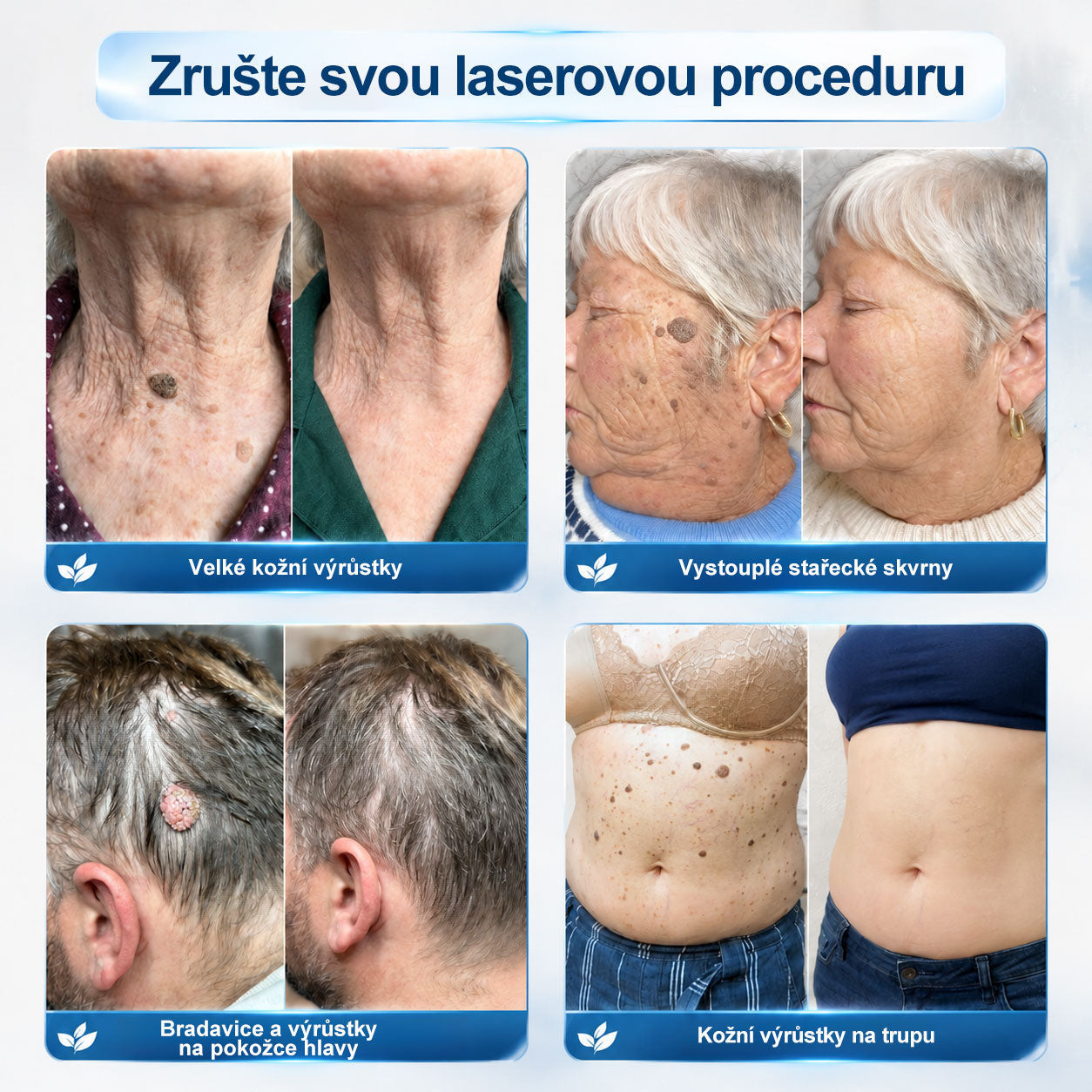 Oficiální značkový obchod🖊️|🎁 Hiskin® 7denní odstraňovač skvrn a pigmentových skvrn (Bezbolestný rollerball bez jizev)🐬