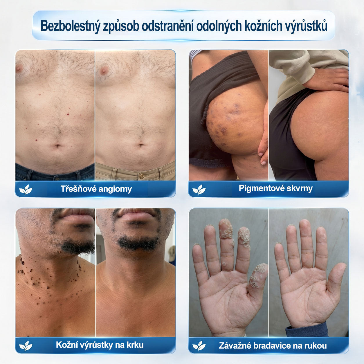 Oficiální značkový obchod🖊️|🎁 Hiskin® 7denní odstraňovač skvrn a pigmentových skvrn (Bezbolestný rollerball bez jizev)🐬