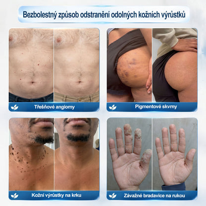 Oficiální značkový obchod🖊️|🎁 Hiskin® 7denní odstraňovač skvrn a pigmentových skvrn (Bezbolestný rollerball bez jizev)🐬